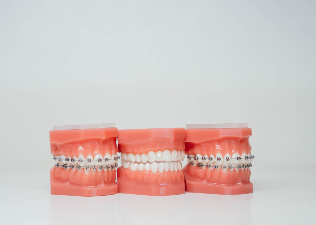 Three orthodontic jaw models lined up, with the center model showing straight teeth and the two outer models showing teeth with traditional metal braces.