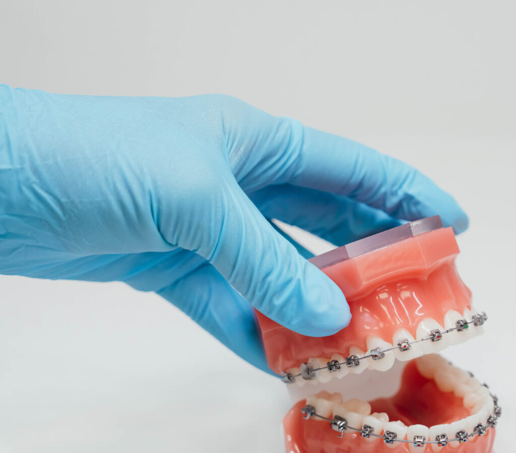 Prince Orthodontics teeth model of invisible braces near American Fork, Utah