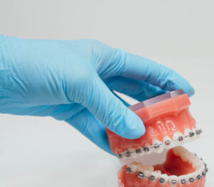 Prince Orthodontics teeth model of invisible braces near American Fork, Utah