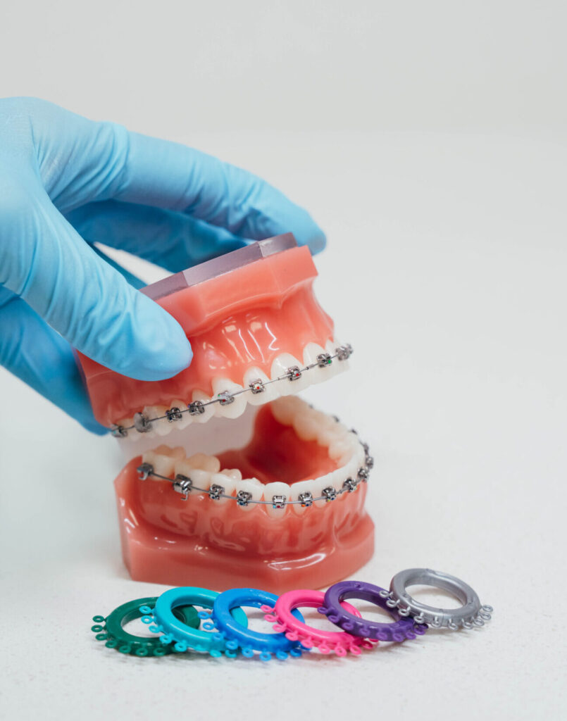 Prince Orthodontics teeth model of braces near American Fork, Utah