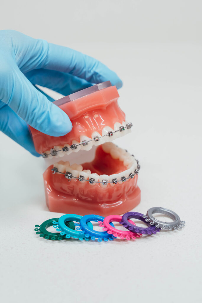 Prince Orthodontics teeth model of braces near American Fork, Utah
