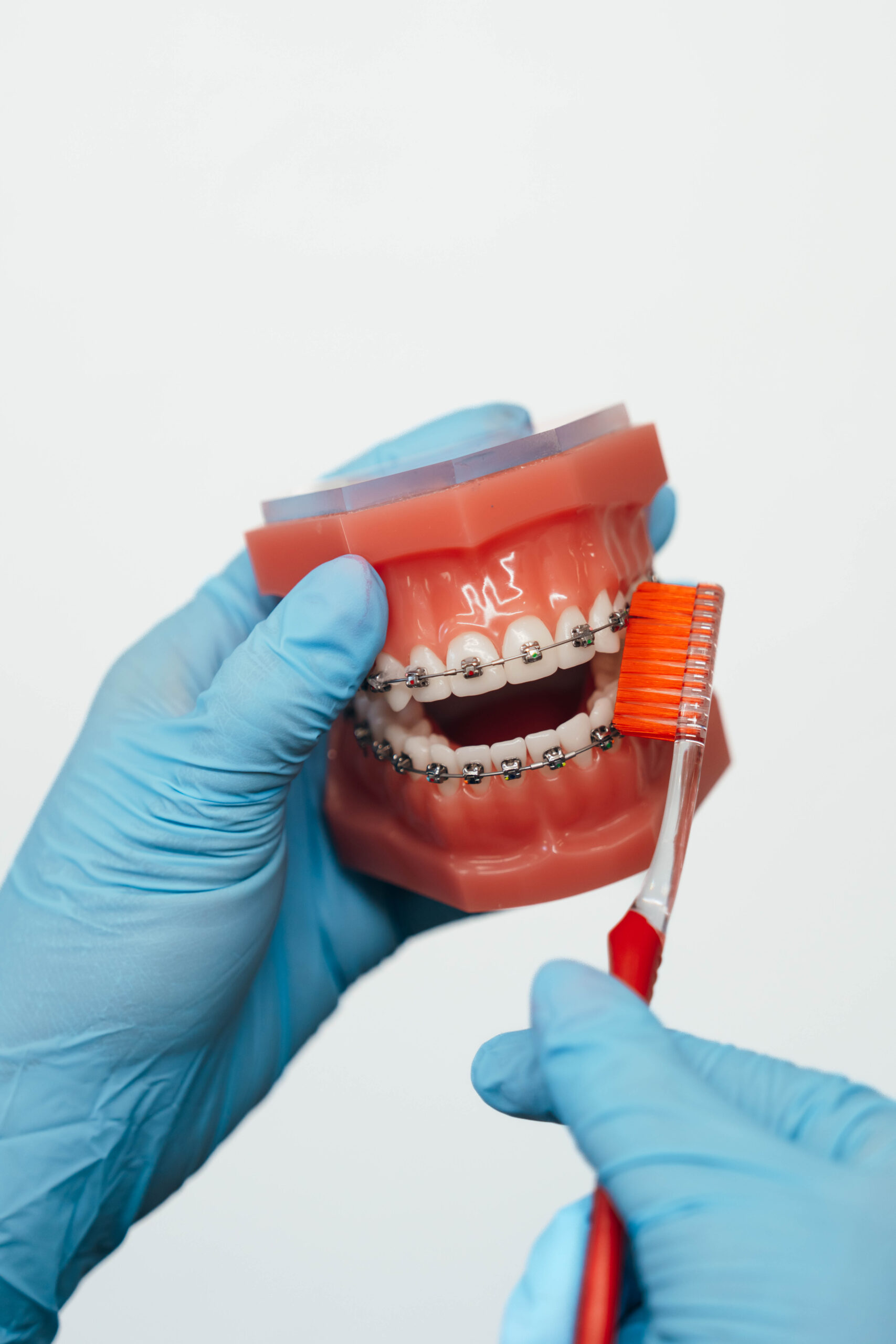 Prince Orthodontics teeth model of braces near American Fork, Utah