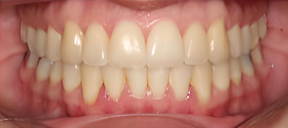prince-orthodontics-gallery-02-after-1920w