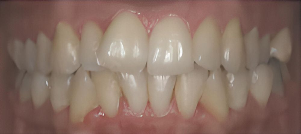 prince-orthodontics-gallery-02-before-1920w