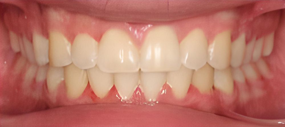 prince-orthodontics-gallery-03-after-1920w