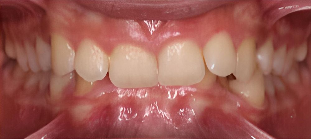 prince-orthodontics-gallery-03-before-1920w