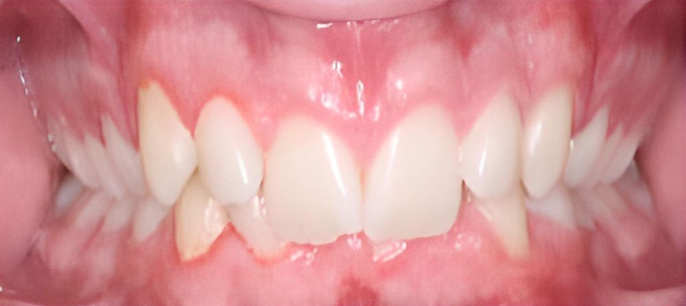 prince-orthodontics-gallery-04-before-1920w