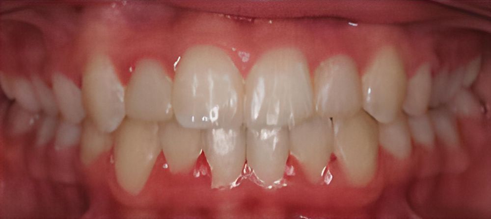 prince-orthodontics-gallery-05-after-1920w