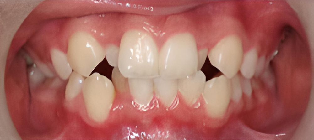 prince-orthodontics-gallery-05-before-1920w