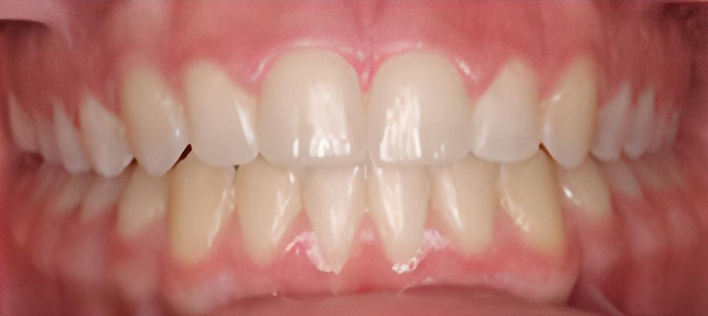 prince-orthodontics-gallery-06-after-1920w (1)