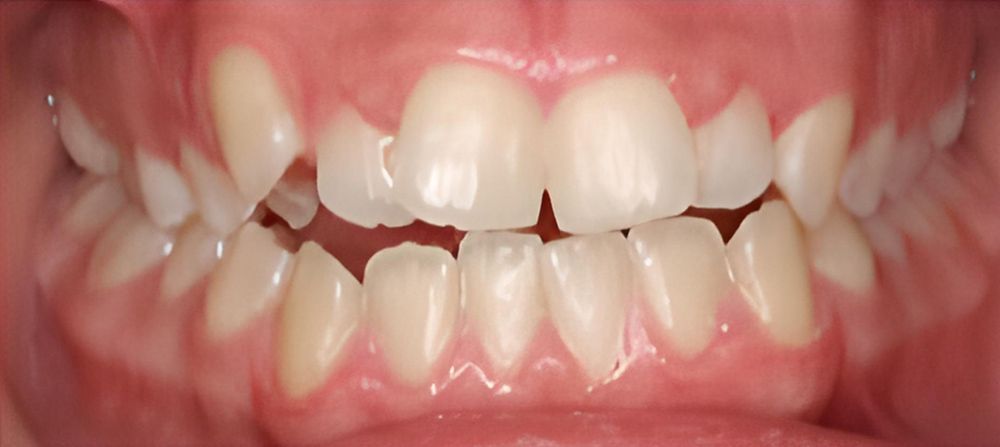 prince-orthodontics-gallery-06-before-1920w