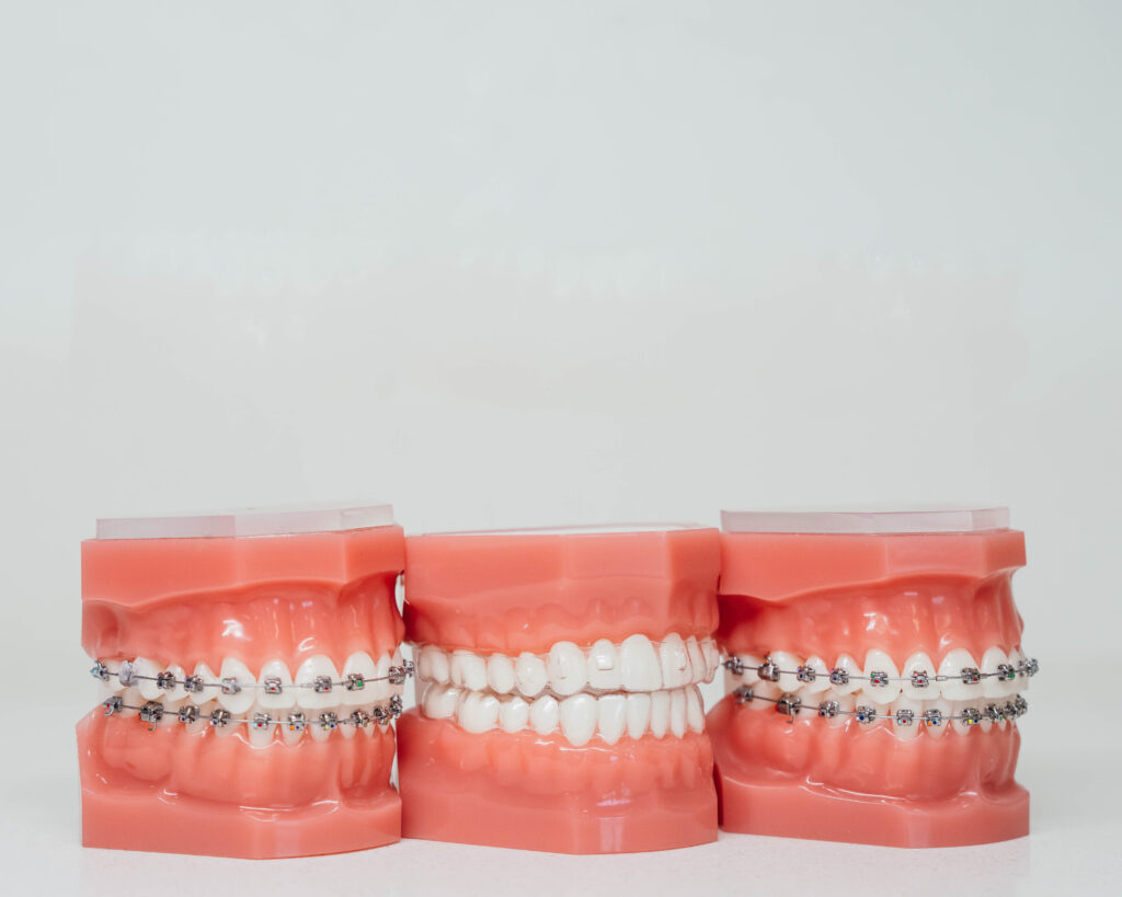 Picture of traditional metal and lingual braces.