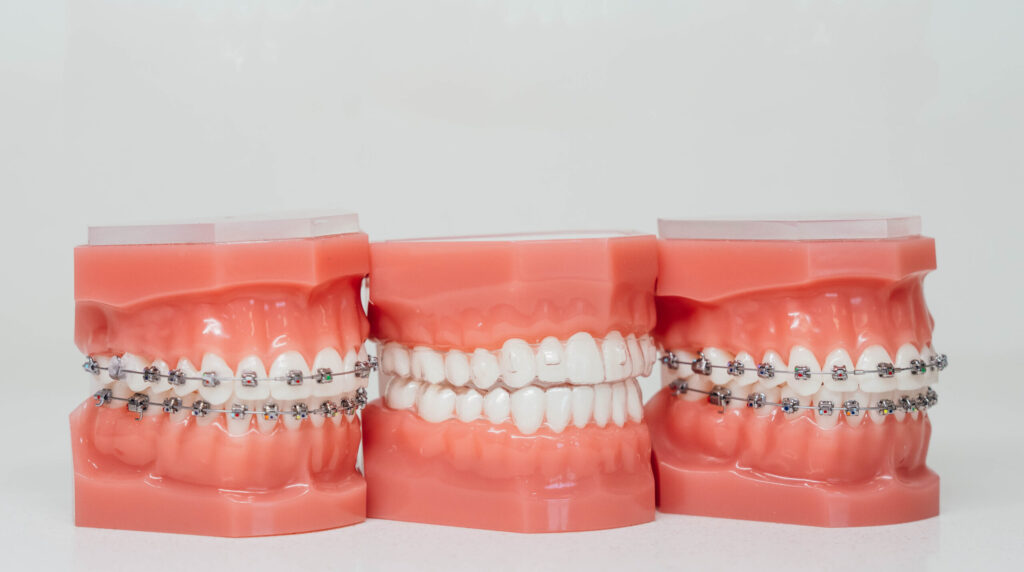 A depiction of braces models.
