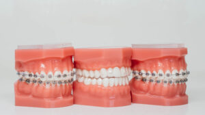 A depiction of braces models.