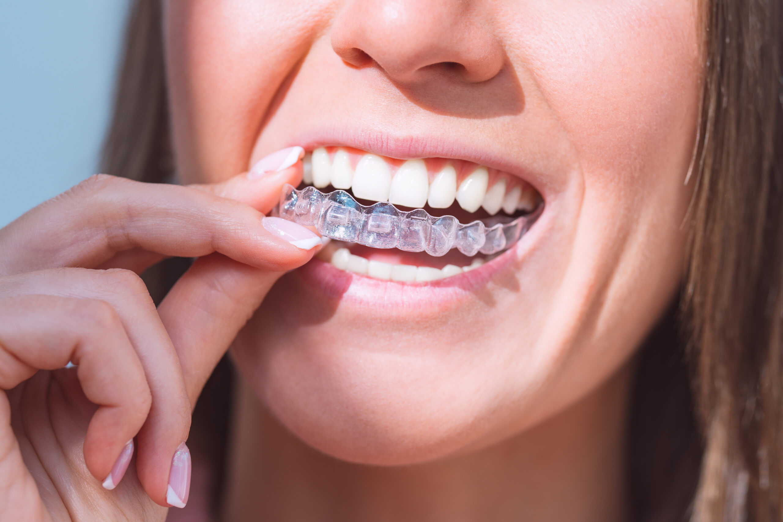 Woman placing a clear retainer onto her teeth, showing good retainer care and daily use.