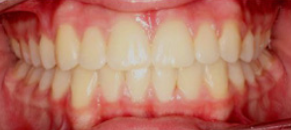 Crooked Teeth Before & After