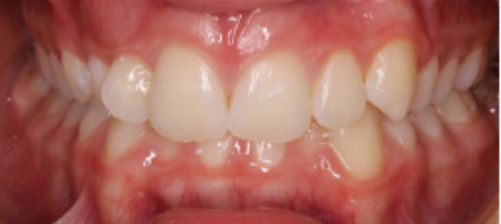 Crooked Teeth Before & After