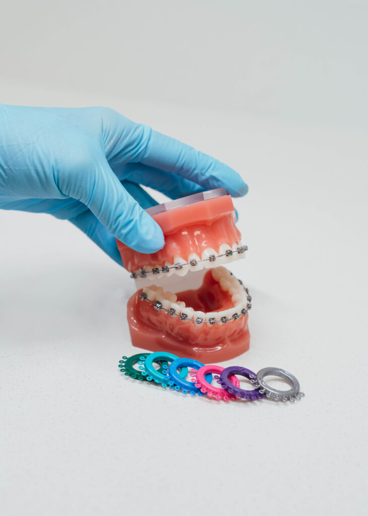 Braces that don't hurt at Prince Orthodontics in American Fork, Utah