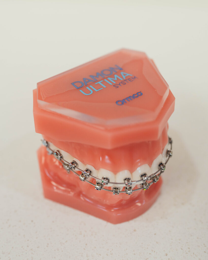 Damon Ultima braces at Prince Orthodontics in American Fork, Utah