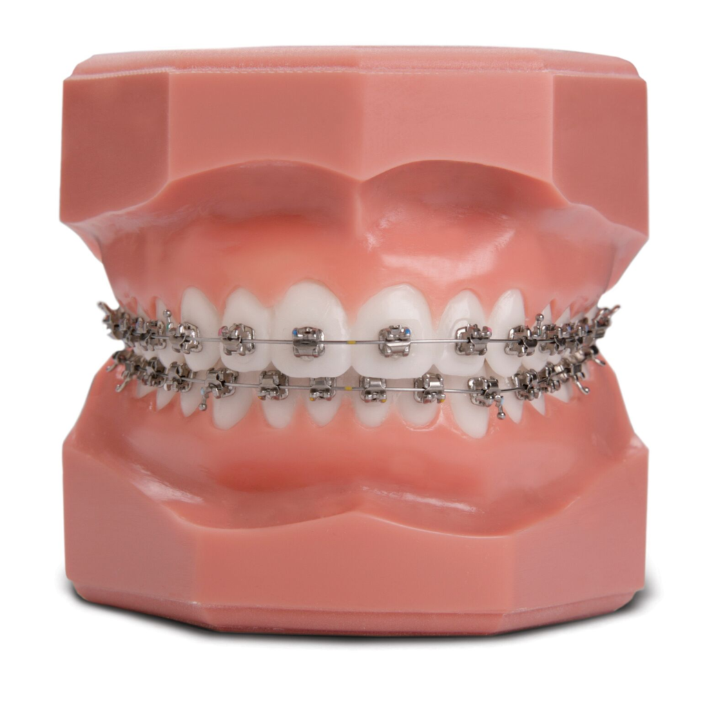 A depiction of braces on teeth.