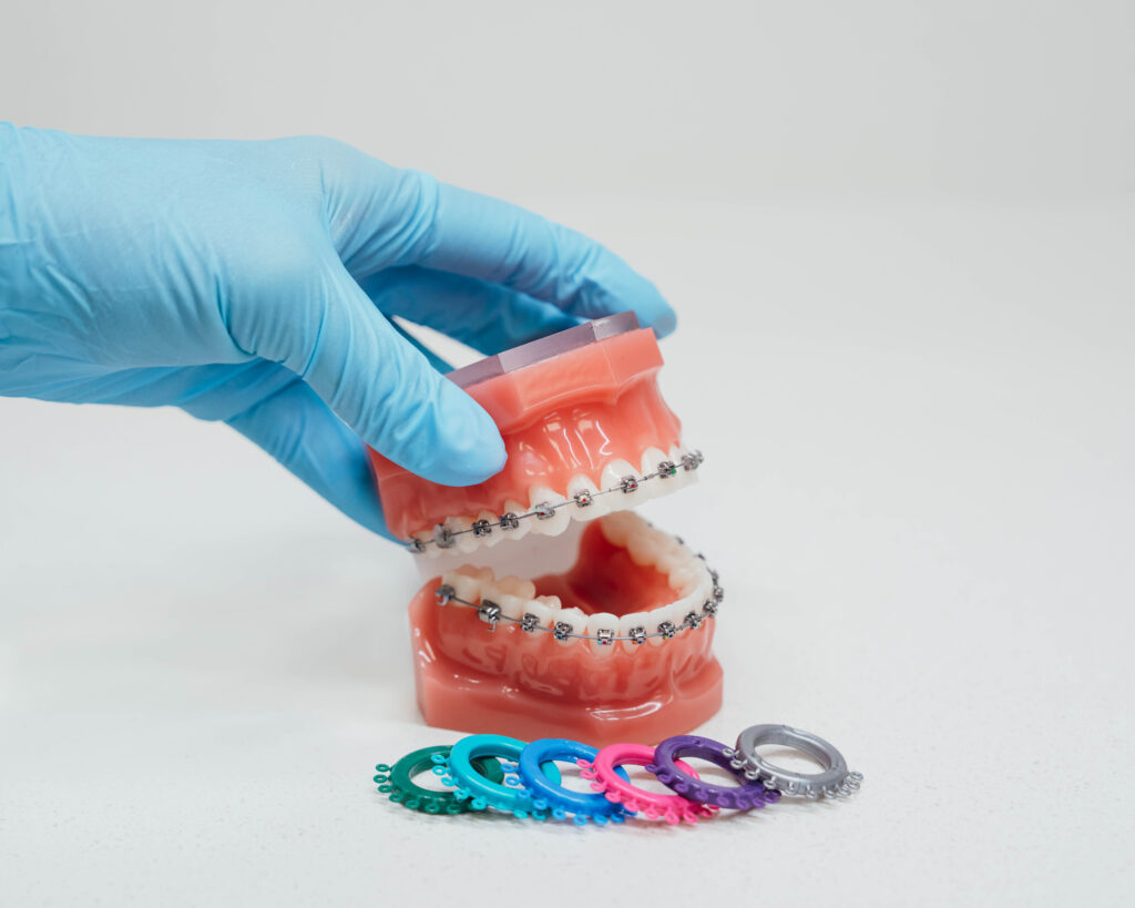 A depiction of Braces