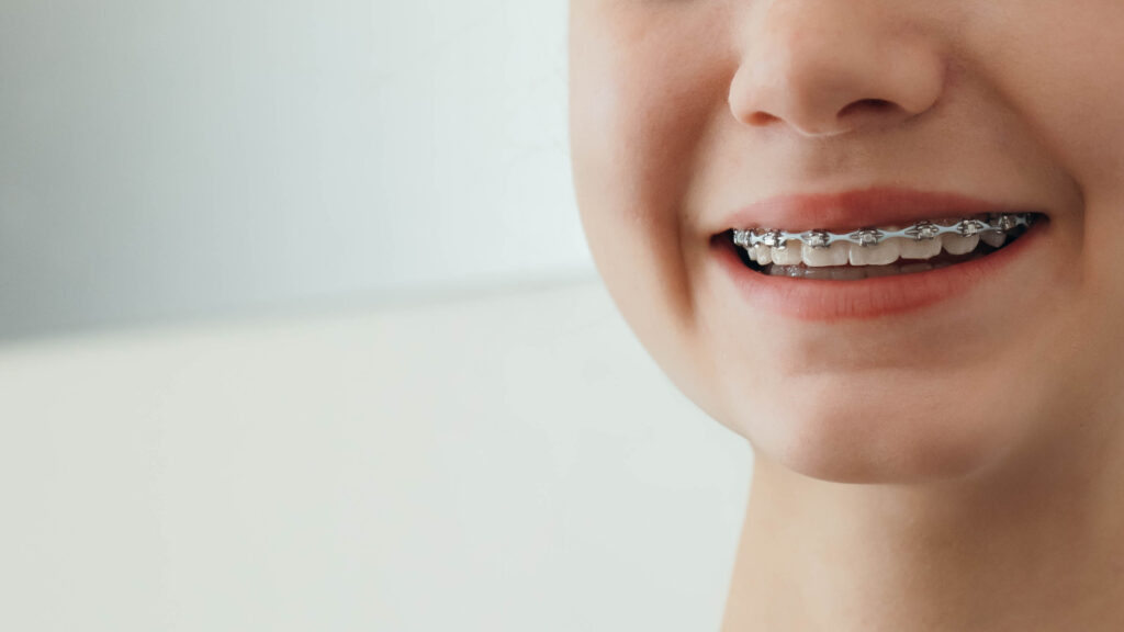 Braces on a pair of teeth.