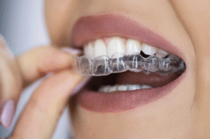 Invisalign aligner being put in.