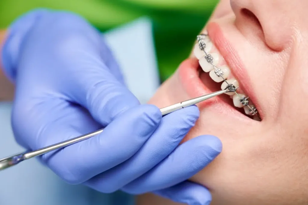 Close up of braces on a patients upper teeth being worked on.