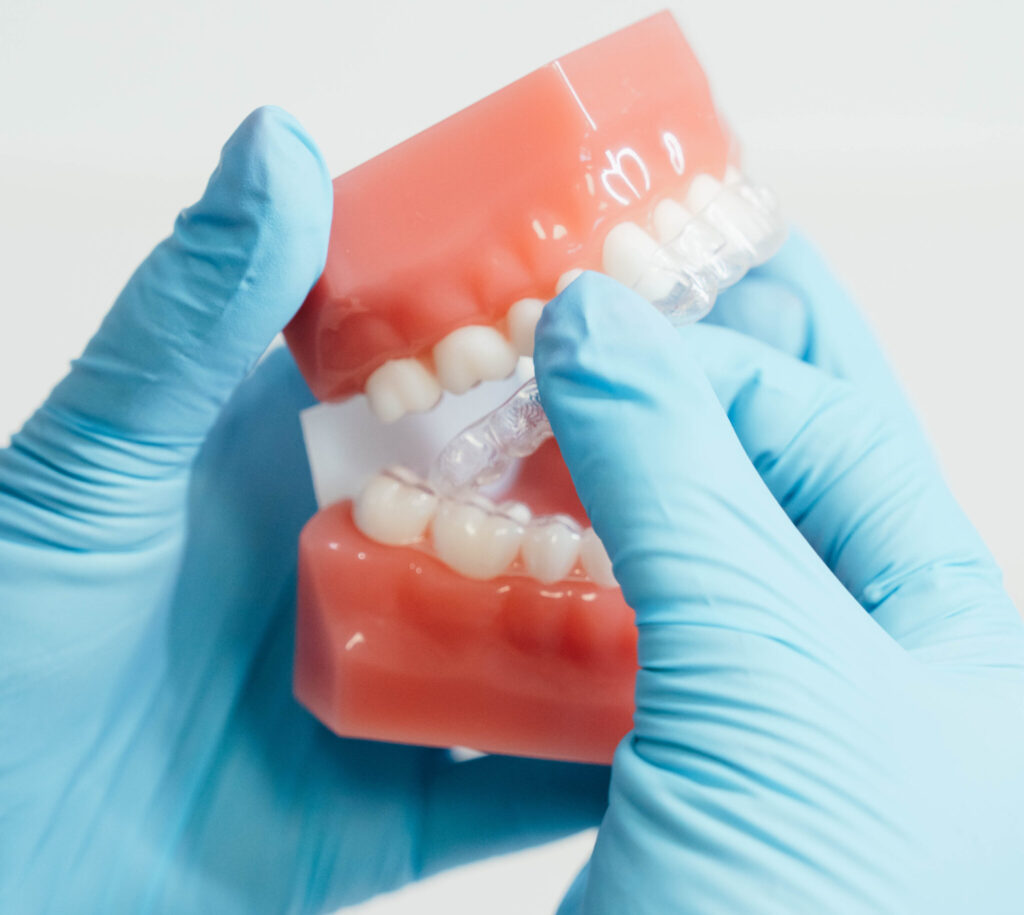 Close up of a clear retainer being put onto a set of teeth.