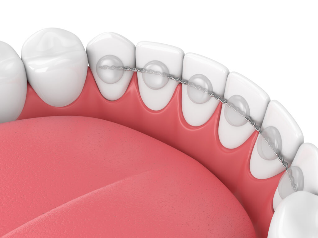 Close up of a permanent retainer on the backside of bottom teeth.