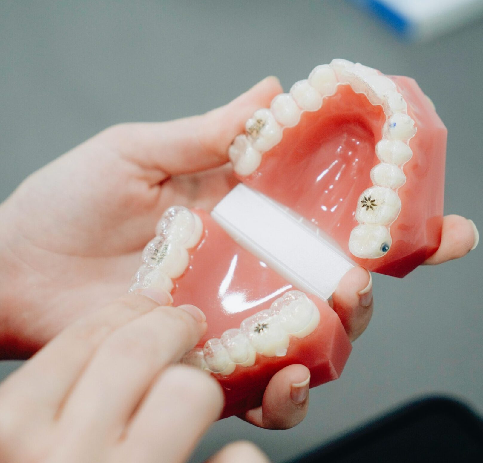 Dental model showing Invisalign clear aligner trays fitted over teeth, demonstrating how aligners straighten teeth over time.
