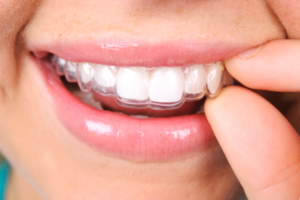 Person with a removable retainer in their mouth.