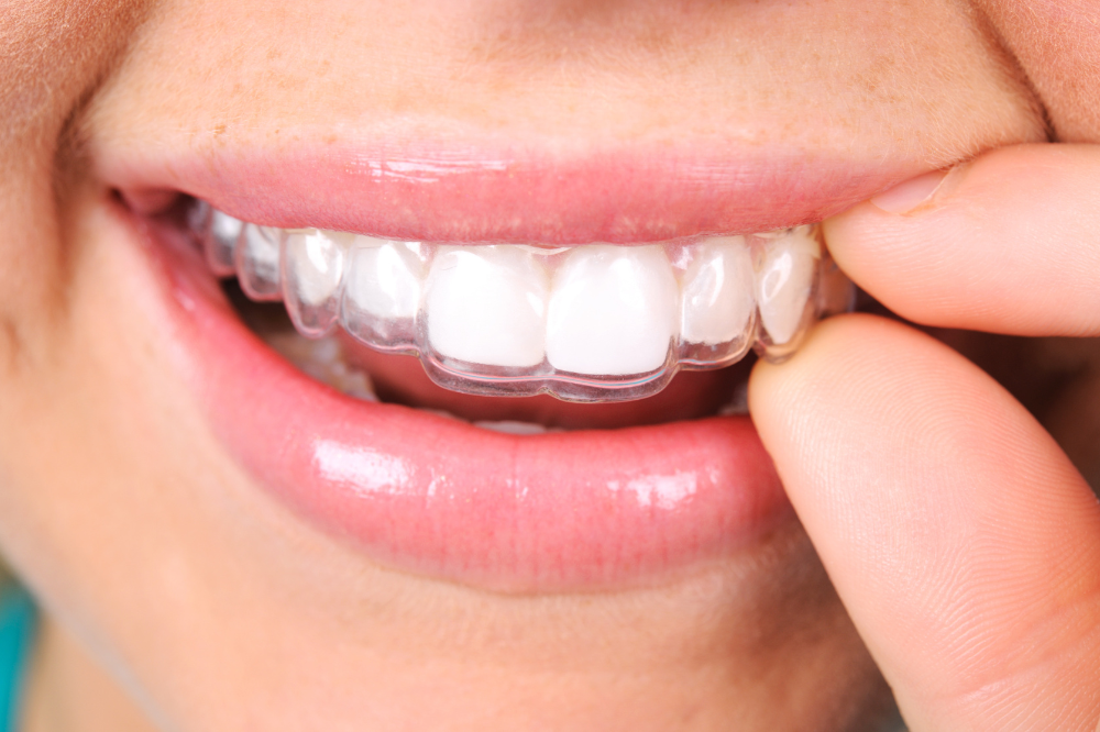 Person with a removable retainer in their mouth.