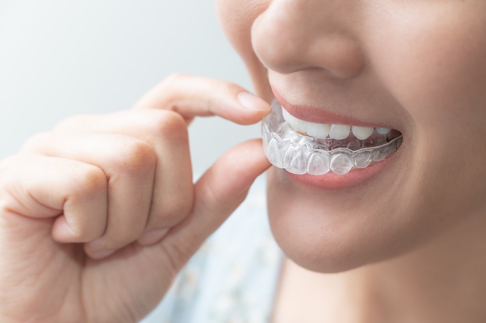 Person inserting a removable retainer into their mouth.