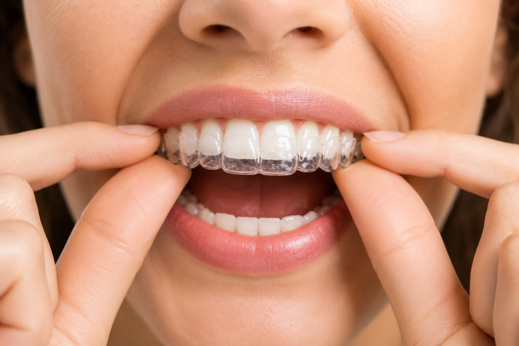 Close-up of a patient fitting a clear orthodontic retainer over straight teeth after braces treatment