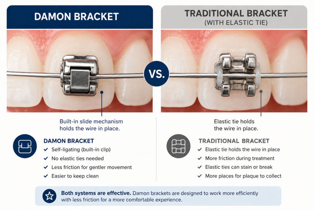 Alt text: Left: a Damon self-ligating bracket. Right: a traditional bracket held by elastic ties. The difference in design drives a meaningful difference in treatment.