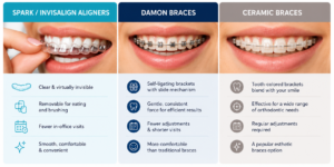 Comparison of Spark aligners, Invisalign, Damon Braces, and ceramic braces as alternatives to traditional braces