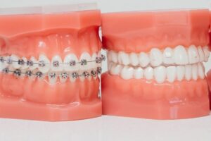 Two dental models displaying different orthodontic treatment options, including braces vs. Invisalign, at Prince Orthodontics in American Fork, UT.