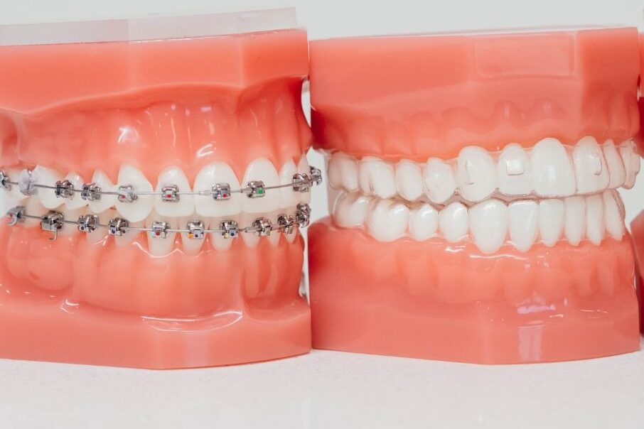 Two dental models displaying different orthodontic treatment options, including braces vs. Invisalign, at Prince Orthodontics in American Fork, UT.